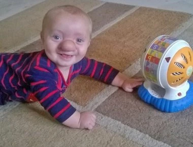 Ένα μωρό πινόκιο: Η μύτη έκρυβε τον εγκέφαλό του (φωτό)